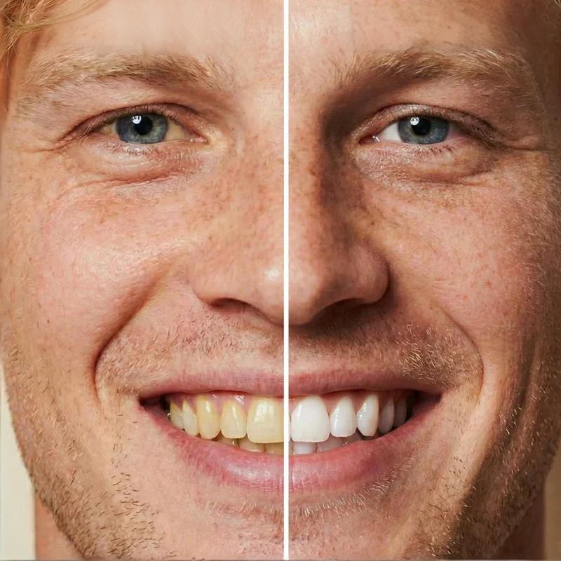 🦷Neuheiten – 40 % Rabatt!🏆Instant Zahnaufhellungsfarbe – 5 ml, Schnelle Wirkung & Einfache Anwendung 😁